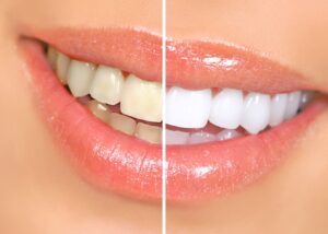 Closeup of a woman's smile that's cut in half to show before/after whitening results